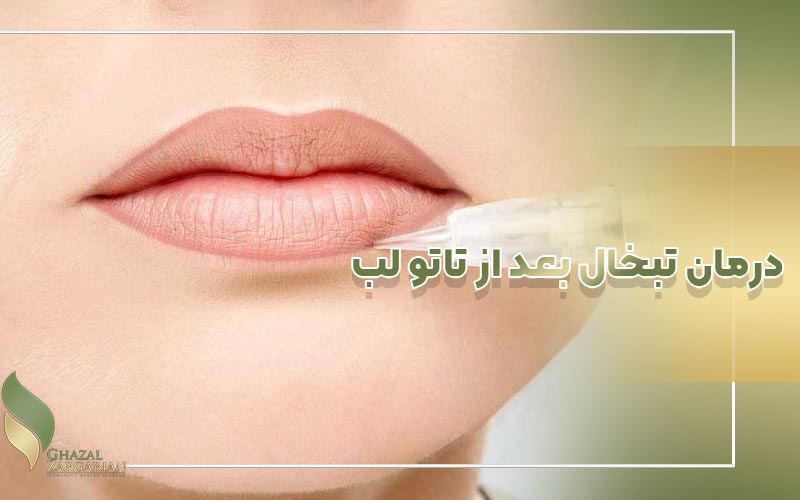 درمان تبخال بعد از تاتو لب
