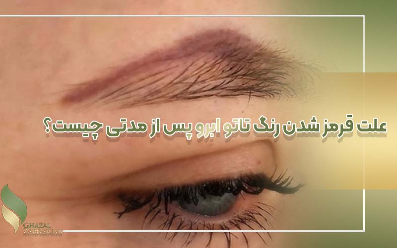 رفع قرمزی تاتو ابرو نی نی سایت