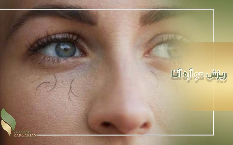 علت ریزش مژه یک چشم