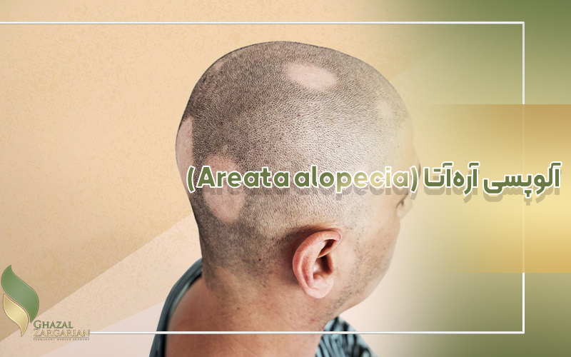 آلوپسی آره‌آتا (Areata alopecia)
