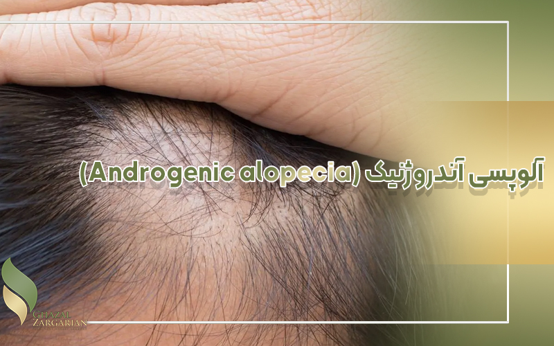 آلوپسی آندروژنیک (Androgenic alopecia)
