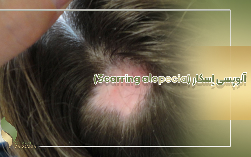 آلوپسی اِسکار (Scarring alopecia)