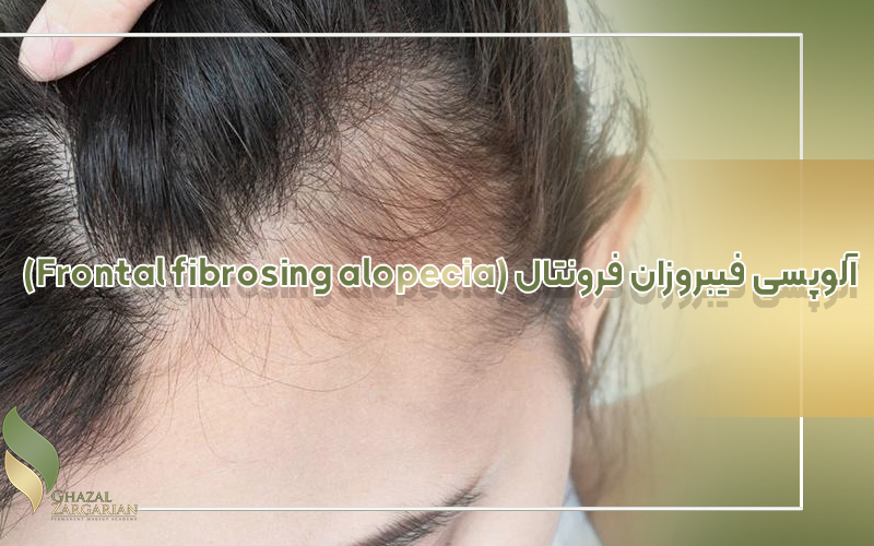 آلوپسی فیبروزان فرونتال (Frontal fibrosing alopecia)