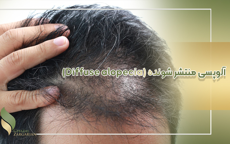 آلوپسی منتشر شونده (Diffuse alopecia)