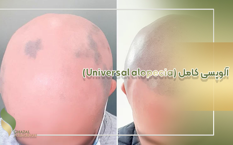 آلوپسی کامل (Universal alopecia)