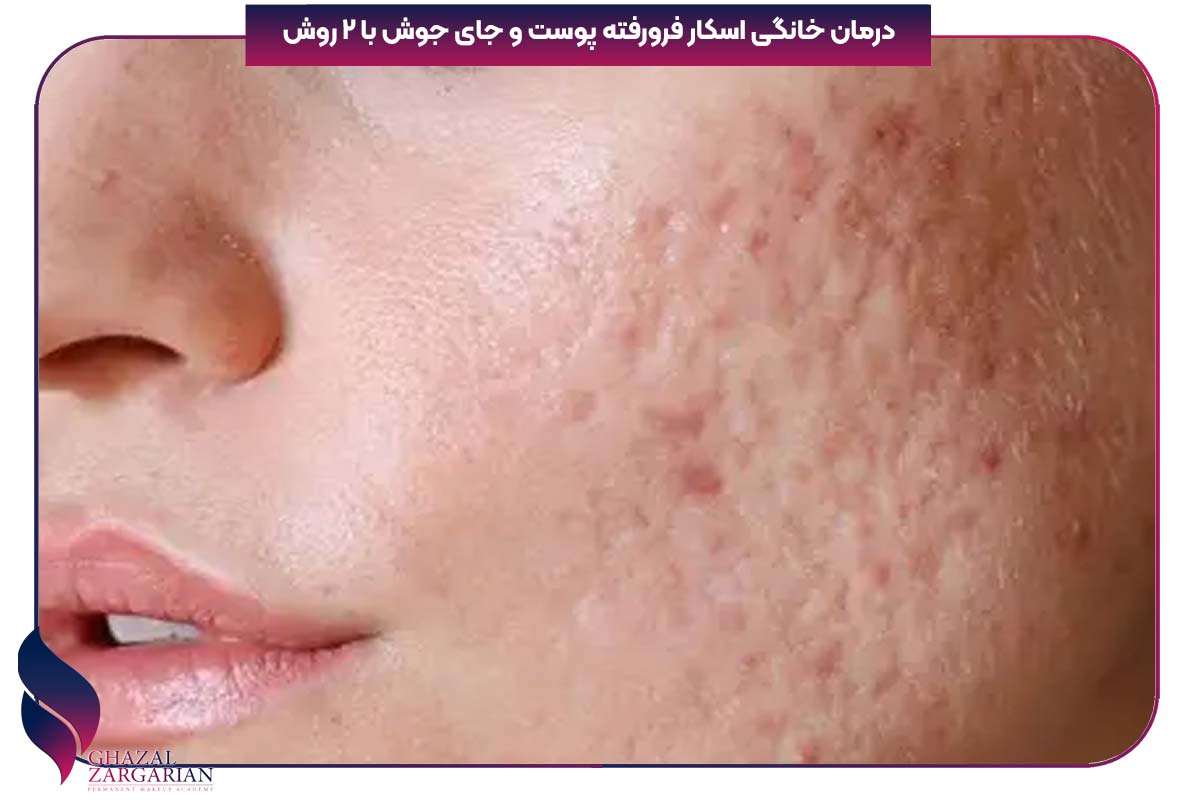 درمان خانگی اسکار فرورفته پوست و جای جوش با 2 روش