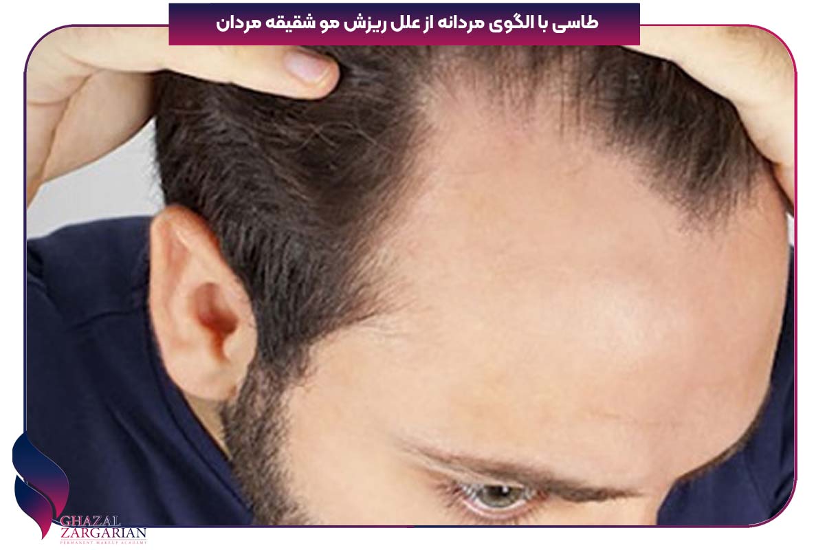 درمان خانگی ریزش موی شقیقه