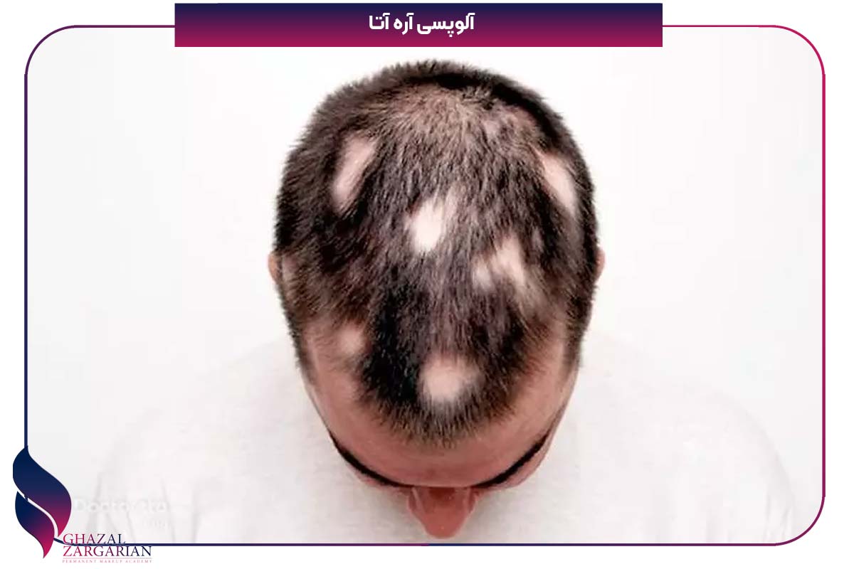 درمان ریزش مو شقیقه