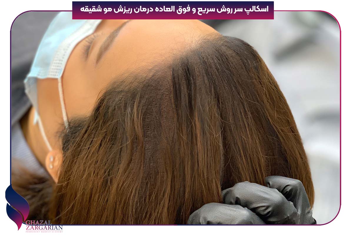 درمان ریزش موی شقیقه ها در زنان 