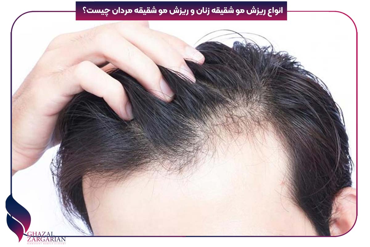 رشد مجدد موهای شقیقه