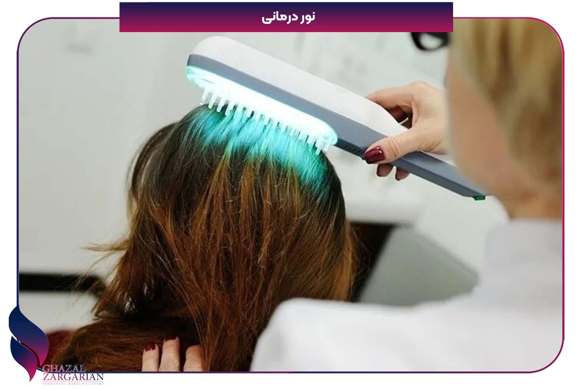 روش‌ های درمانی ریزش مو ناشی از سندرم تخمدان پلی کیستیک