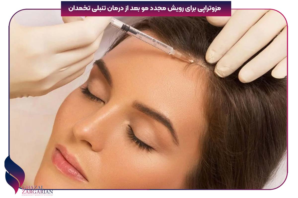 رویش مجدد مو بعد از درمان تنبلی تخمدان 