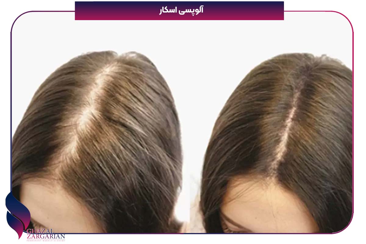 ریزش شقیقه سر