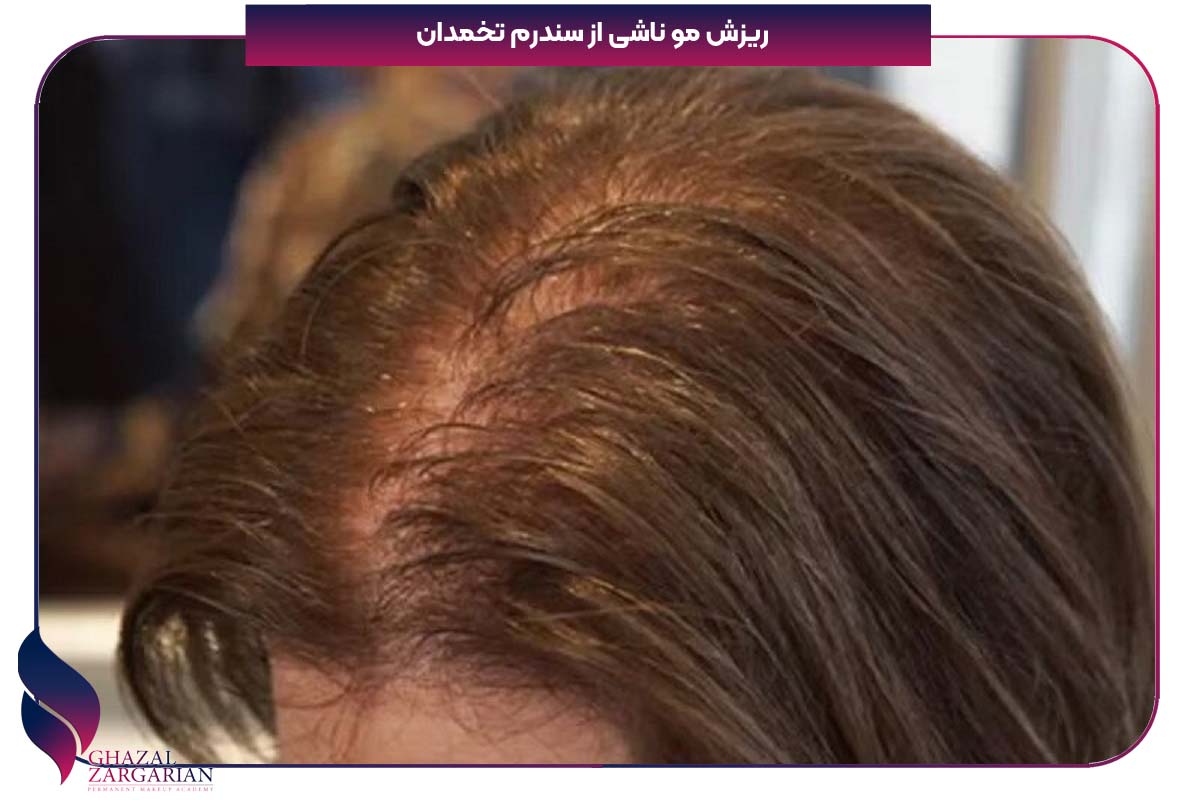 ریزش مو از شقیقه