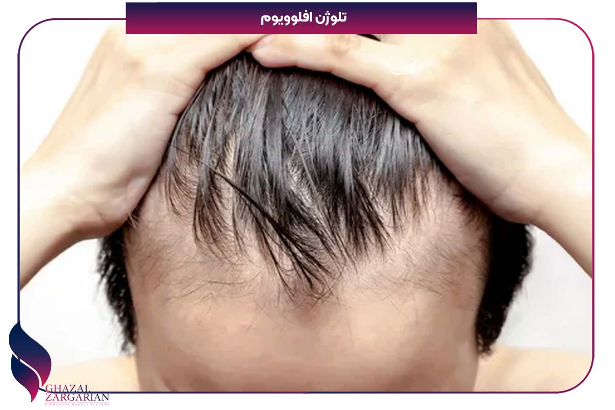 ریزش مو شقیقه طب سنتی