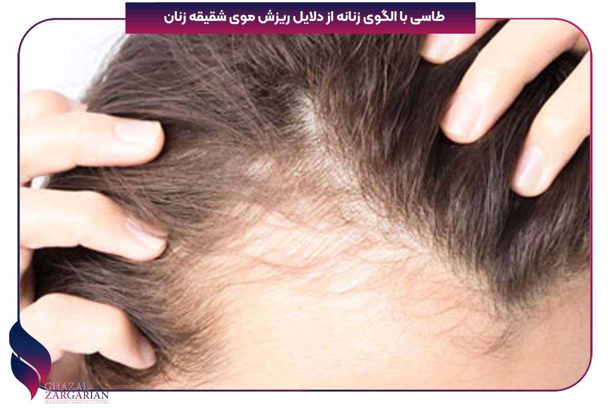 ریزش مو شقیقه