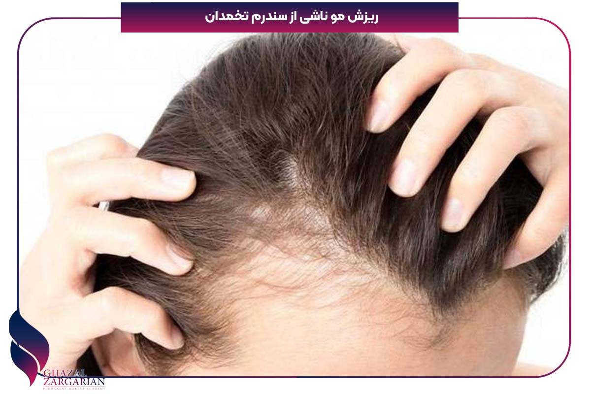 ریزش مو ناشی از سندرم تخمدان