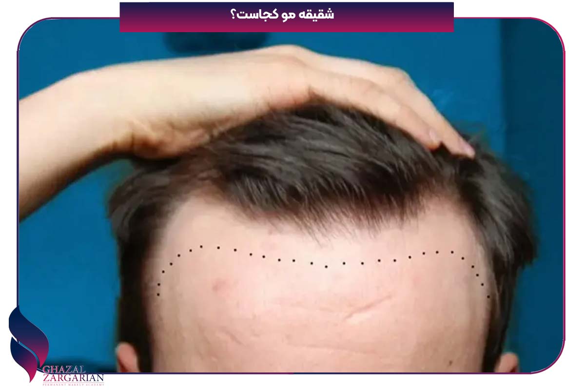 شقیقه مو کجاست
