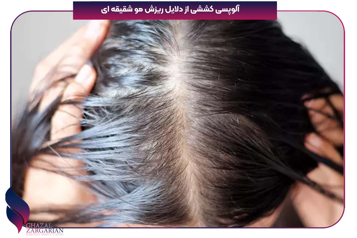 علت خالی شدن شقیقه ها در زنان