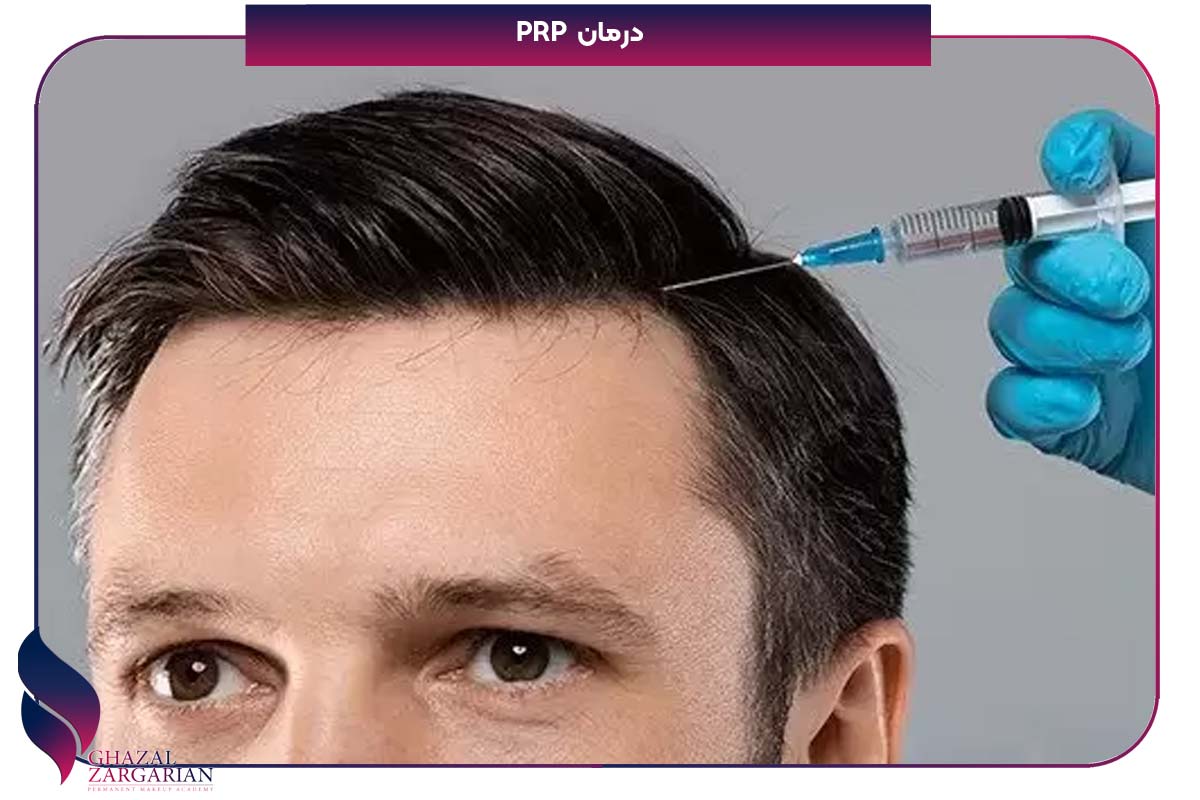 علت ریزش مو از شقیقه ها