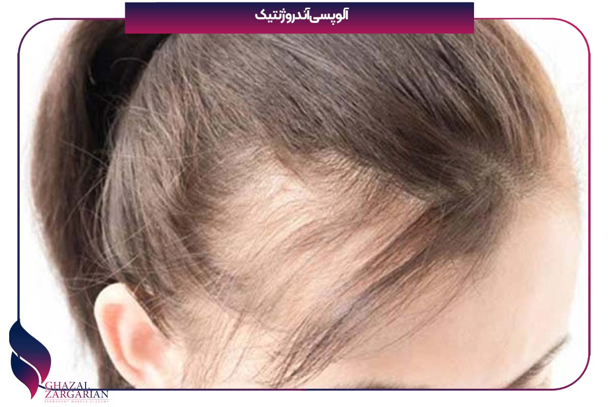 پر شدن موهای شقیقه