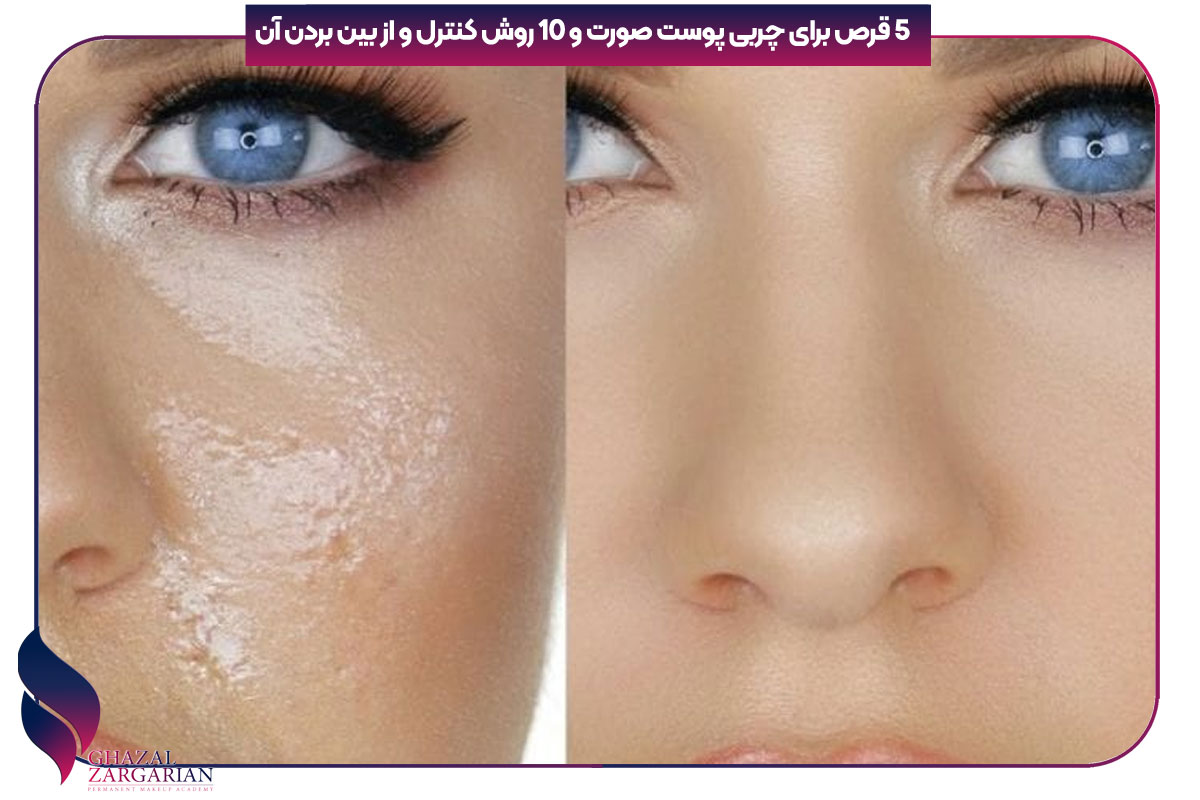5 قرص برای چربی پوست صورت و 10 روش کنترل و از بین بردن آن
