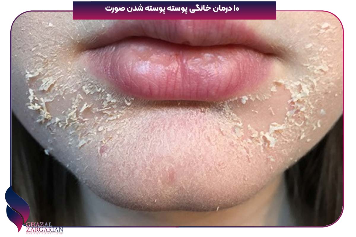 10 درمان خانگی پوسته پوسته شدن صورت