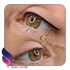 انواع بن مژه انواع بن مژه