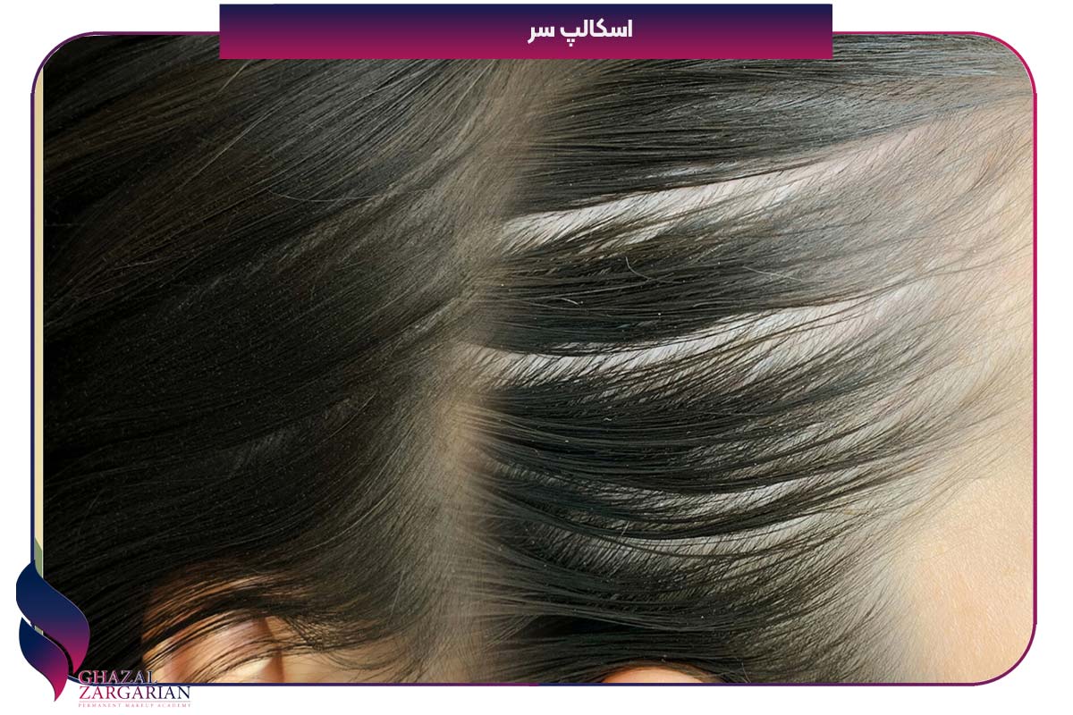 برای ریزش مو چی خوبه درمان خانگی