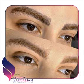 بعد از ریموو ابرو چیکار کنیم بعد از ریموو ابرو چیکار کنیم