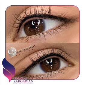بن مژه پلک پایین بن مژه پلک پایین