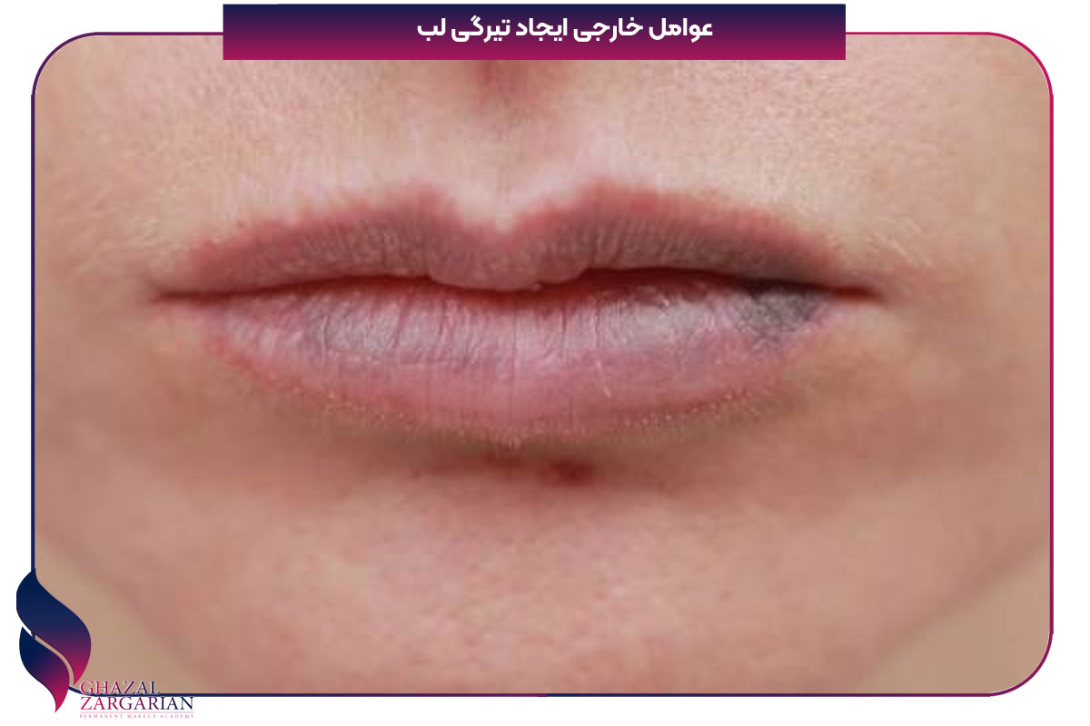 رفع کبودی لب