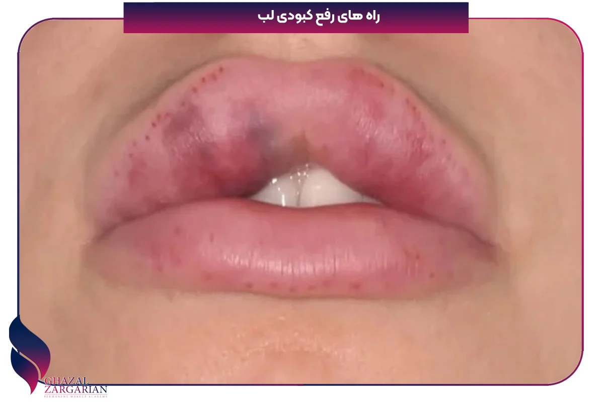 علت کبودی لب زنان