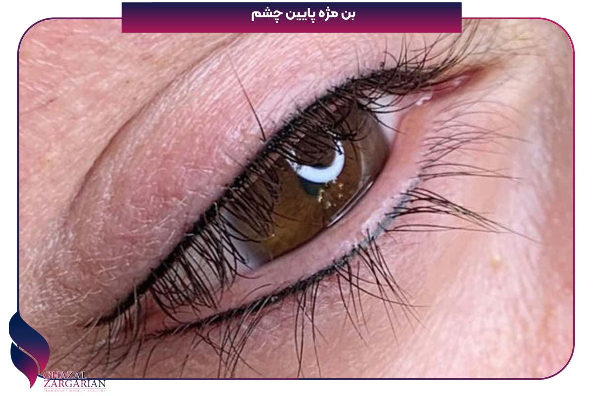 عوارض بن مژه