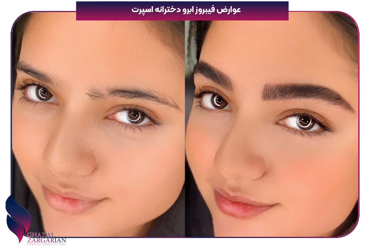 عوارض فیبروز ابرو دخترانه اسپرت 
