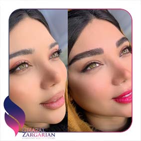 عکس فیبروز بعد از یک ماه