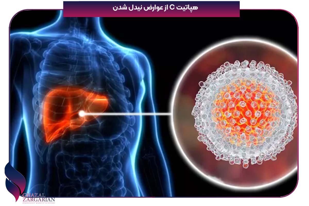 فلوچارت نیدل استیک شدن