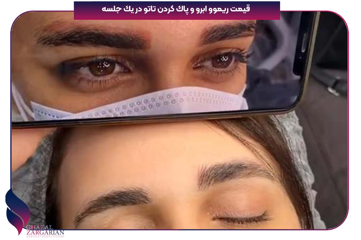 قیمت ریموو تاتو ابرو