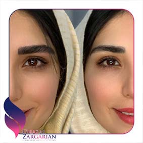 مدل های فیبروز ابرو