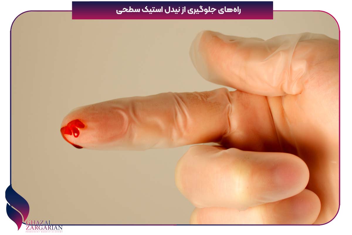 نیدل شدن چیست