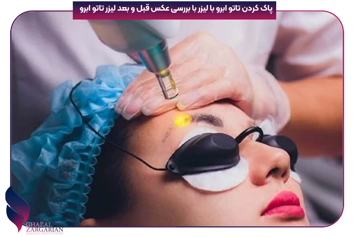 پاک کردن تاتو ابرو با لیزر با بررسی عکس قبل و بعد لیزر تاتو ابرو