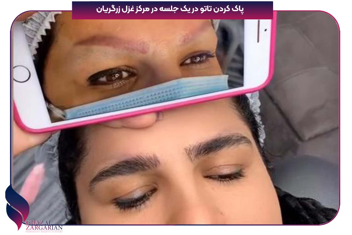 پاک کردن تاتو ابرو در یک جلسه