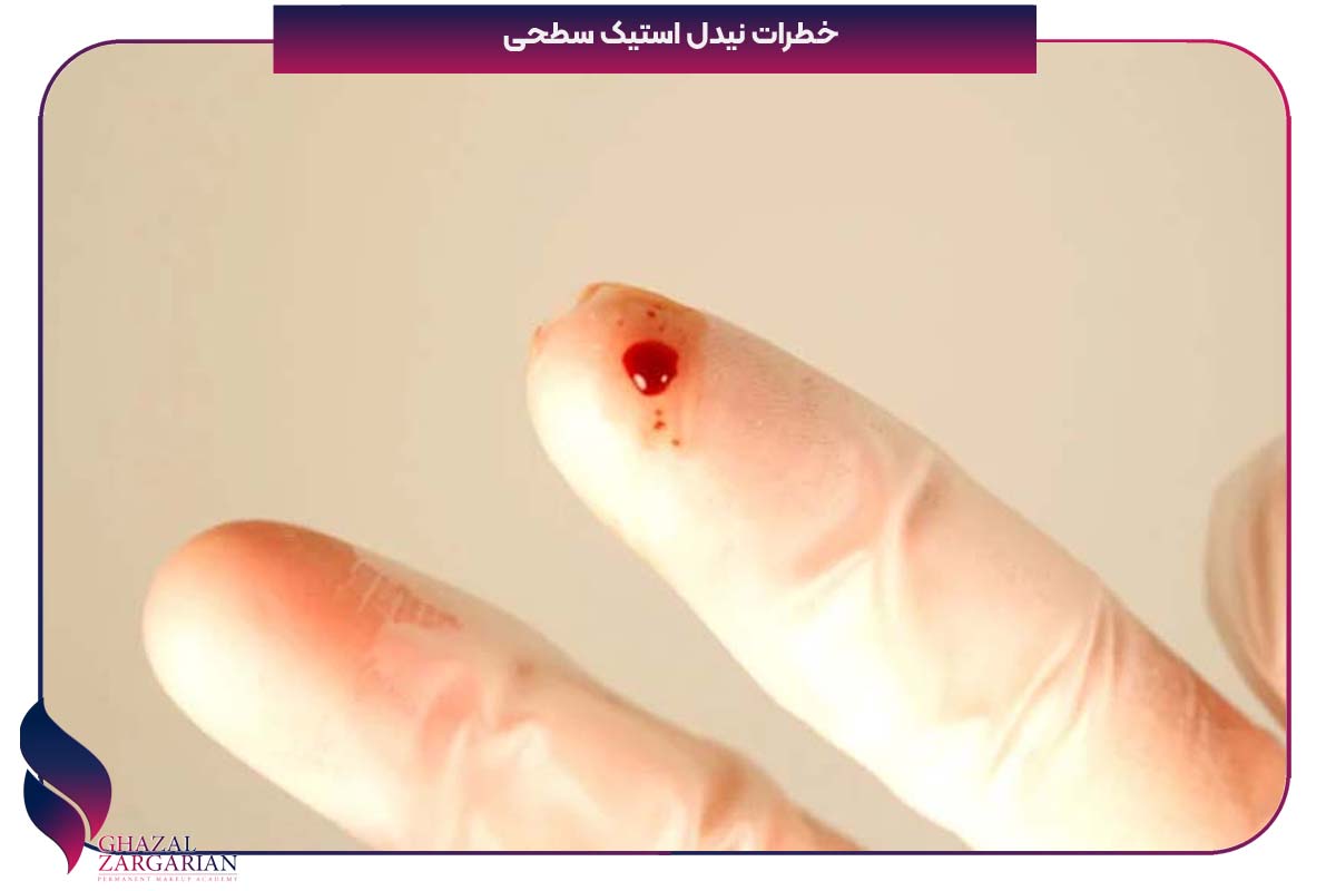 پروتکل نیدل استیک