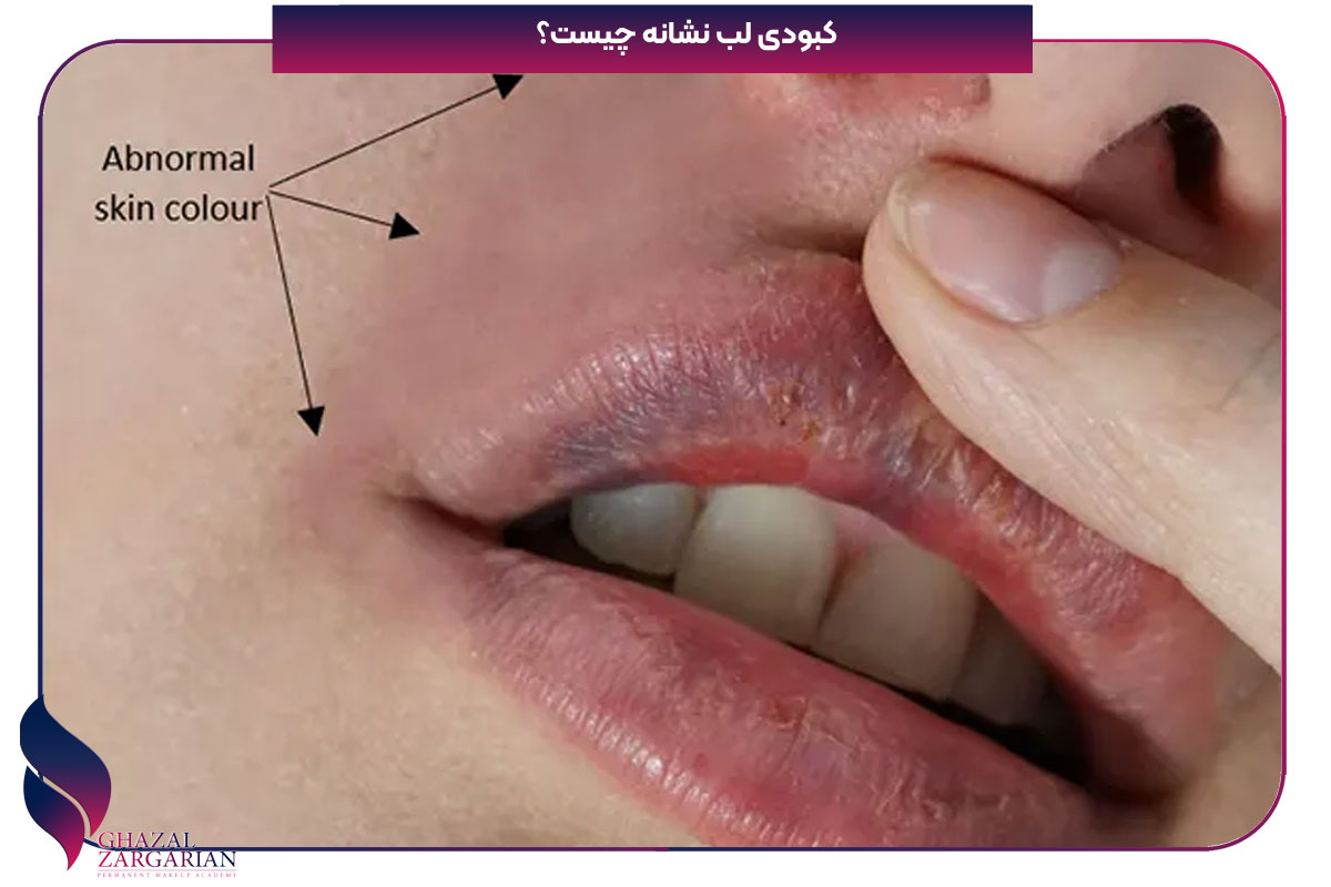 کبودی لب نشانه چیست