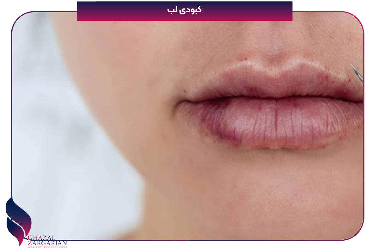 کبودی لب