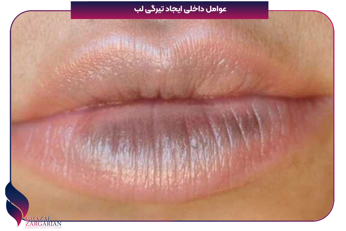 کمبود کدام ویتامین باعث سیاهی لب میشود