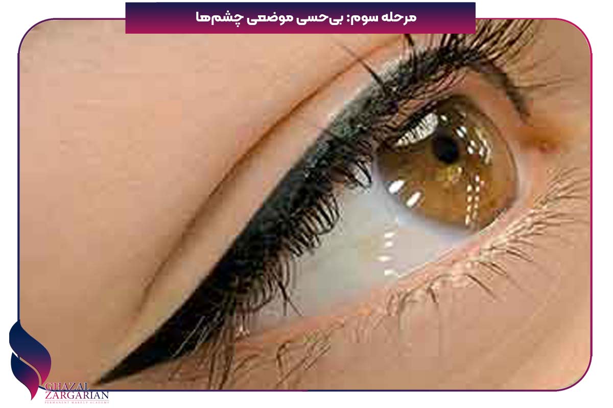 خدمات فیکانتور چشم