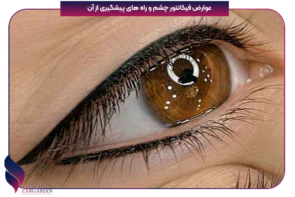 کانتور زیر چشم