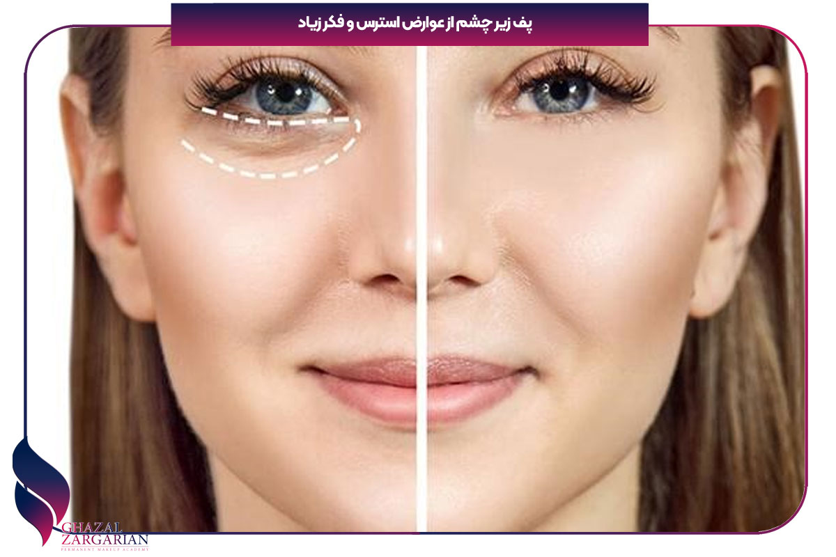 استرس وخارش