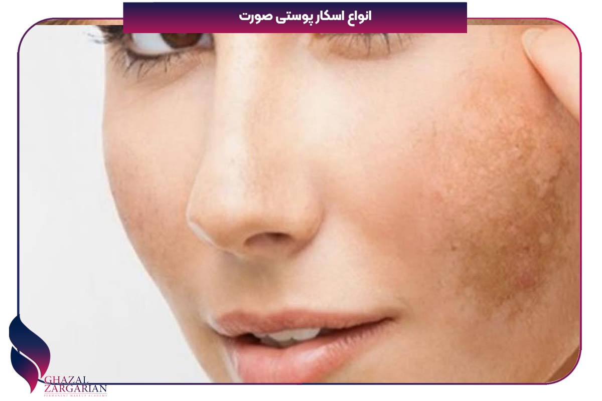 اسکار فرورفته